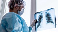 علائم درگیری ریه پس از ابتلا به کرونا