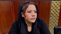 فیلم/ سر خونین یک زن افغان بر اثر ضرب و شتم طالبان