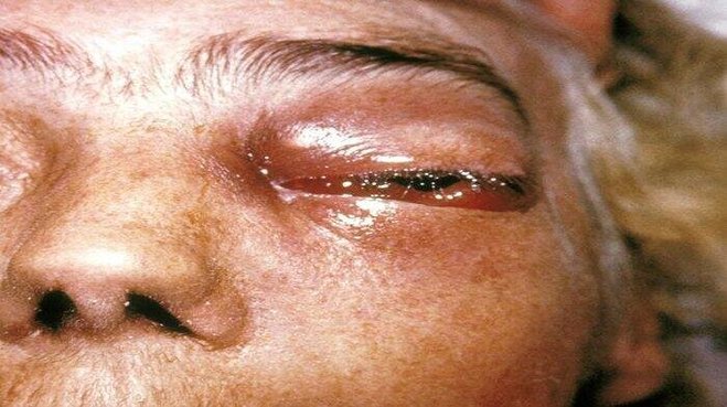 آمار ابتلا به قارچ سیاه در ایران | قارچ سیاه کشنده است؟