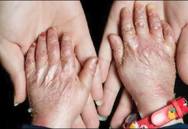 واکنش جدید وزارت بهداشت به خبر گم شدن پانسمان‌های بیماران پروانه‌ای