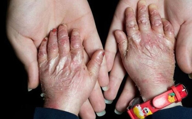 ماجرای گم شدن ۲۵۰۰ کیلو پانسمان بیماران پروانه‌ای