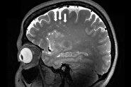 برای اولین بار؛ دانشمندان از میگرن در مغز عکسبرداری کردند! +تصویر