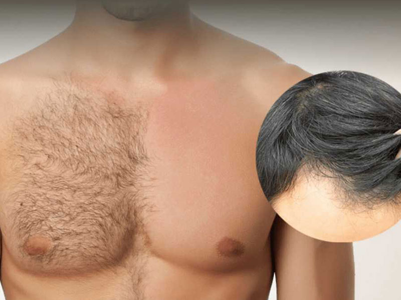 روش‌های کاشت موی طبیعی برای آقایان و خانم‌ها