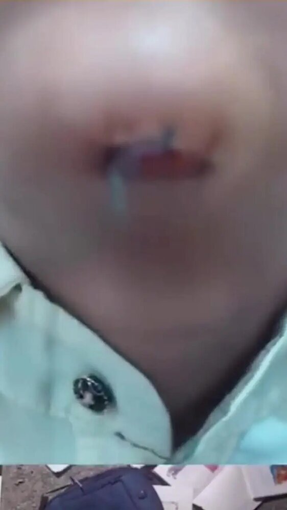 عکس تلخ از  ضرب و جرح دانش آموز ۶ ساله در مدرسه | قطرهای اشک با چانهای شکسته! عکس تلخ از  ضرب و جرح دانش آموز ۶ ساله در مدرسه | قطرهای اشک با چانهای شکسته!